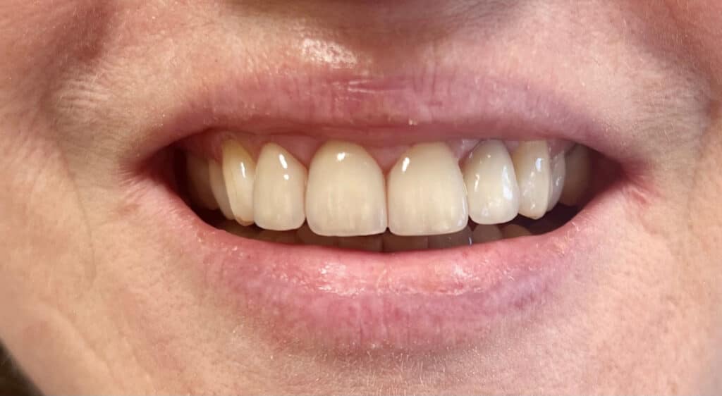 frontzahnkronen_nachher