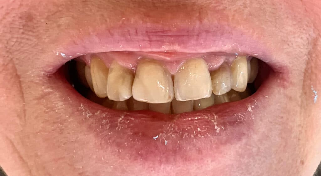 frontzahnkronen_vorher